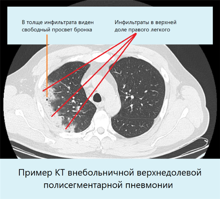 Реабилитация после пневмонии